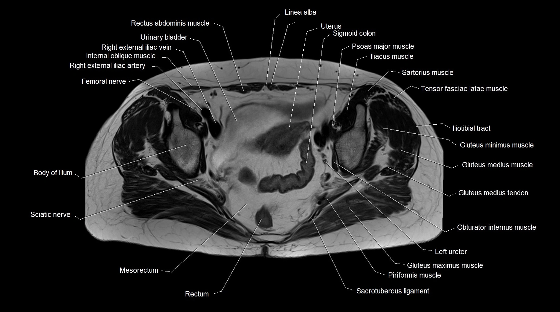 MRI 3T pelvis axial cross section anatomy image 18.webp